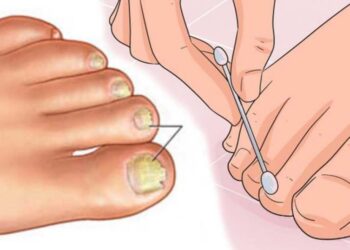 Nagelpilz? Mit diesem Wundermittel aus Ihrer Küche können Sie es in kürzester Zeit loswerden!