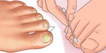 Nagelpilz? Mit diesem Wundermittel aus Ihrer Küche können Sie es in kürzester Zeit loswerden!