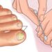 Nagelpilz? Mit diesem Wundermittel aus Ihrer Küche können Sie es in kürzester Zeit loswerden!