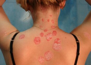 Diese Pflanze scheint gut gegen Psoriasis und Hautkrankheiten zu sein