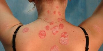 Diese Pflanze scheint gut gegen Psoriasis und Hautkrankheiten zu sein